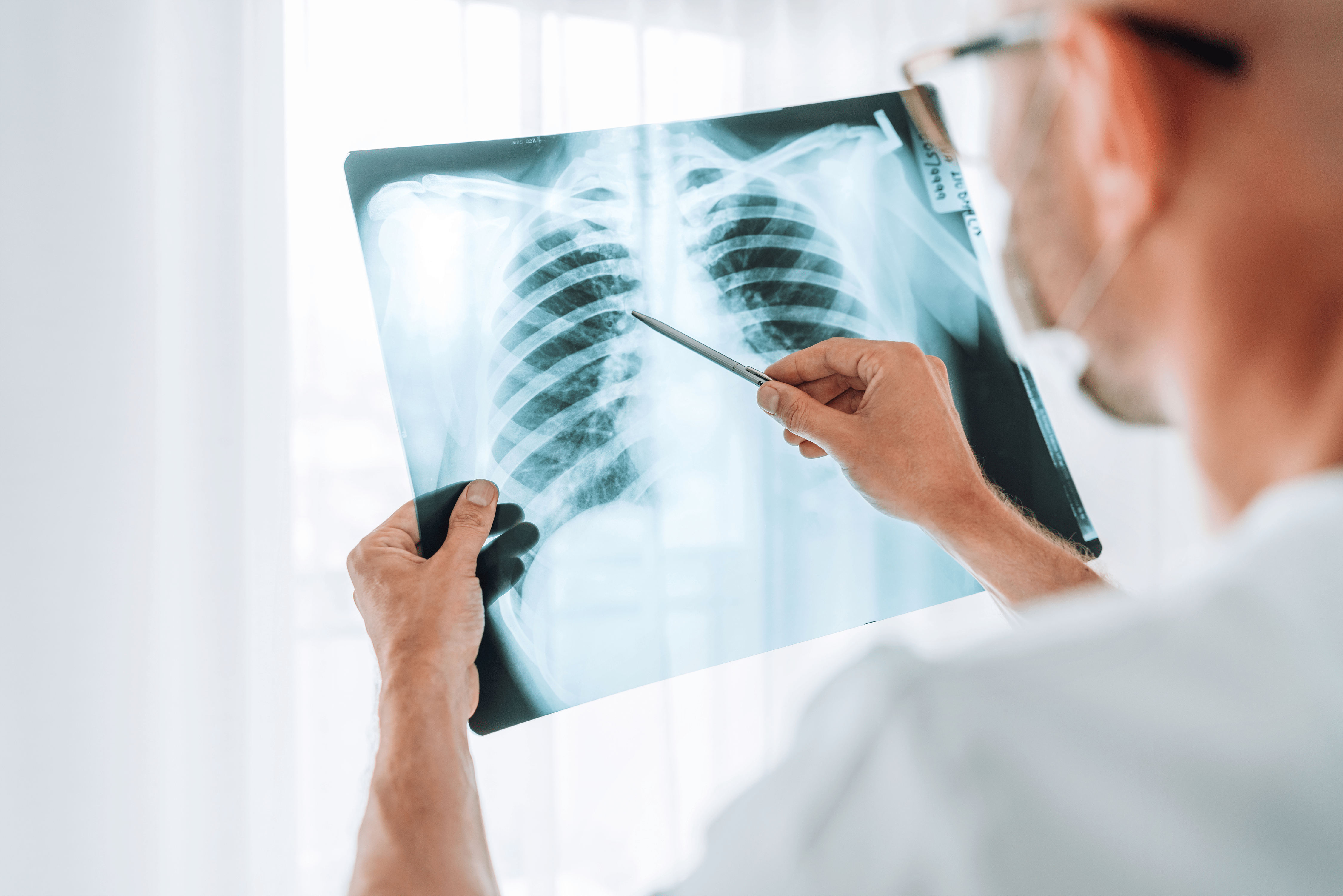 lung cancer