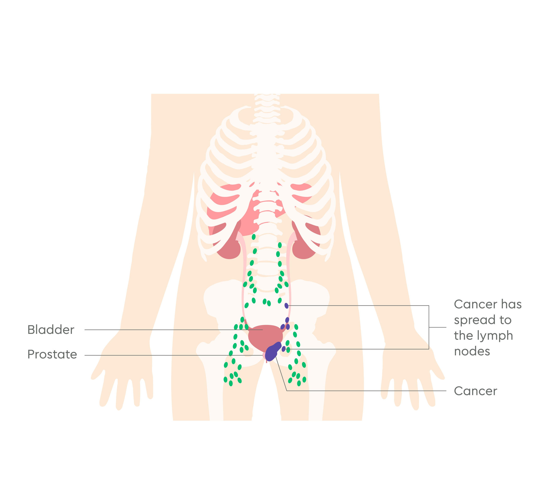 3380_UK_Prostate cancer stages illustrations_V1_FA