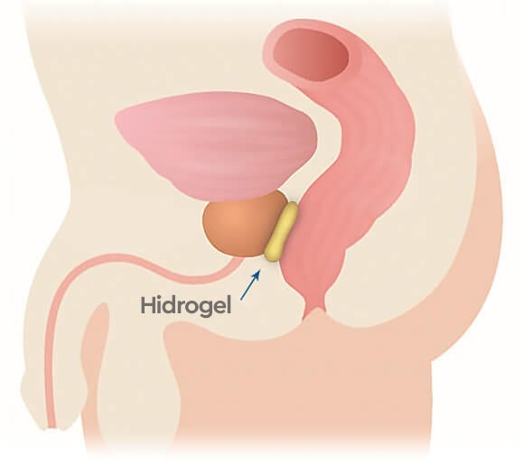 Posicionamiento del espaciador de hidrogel