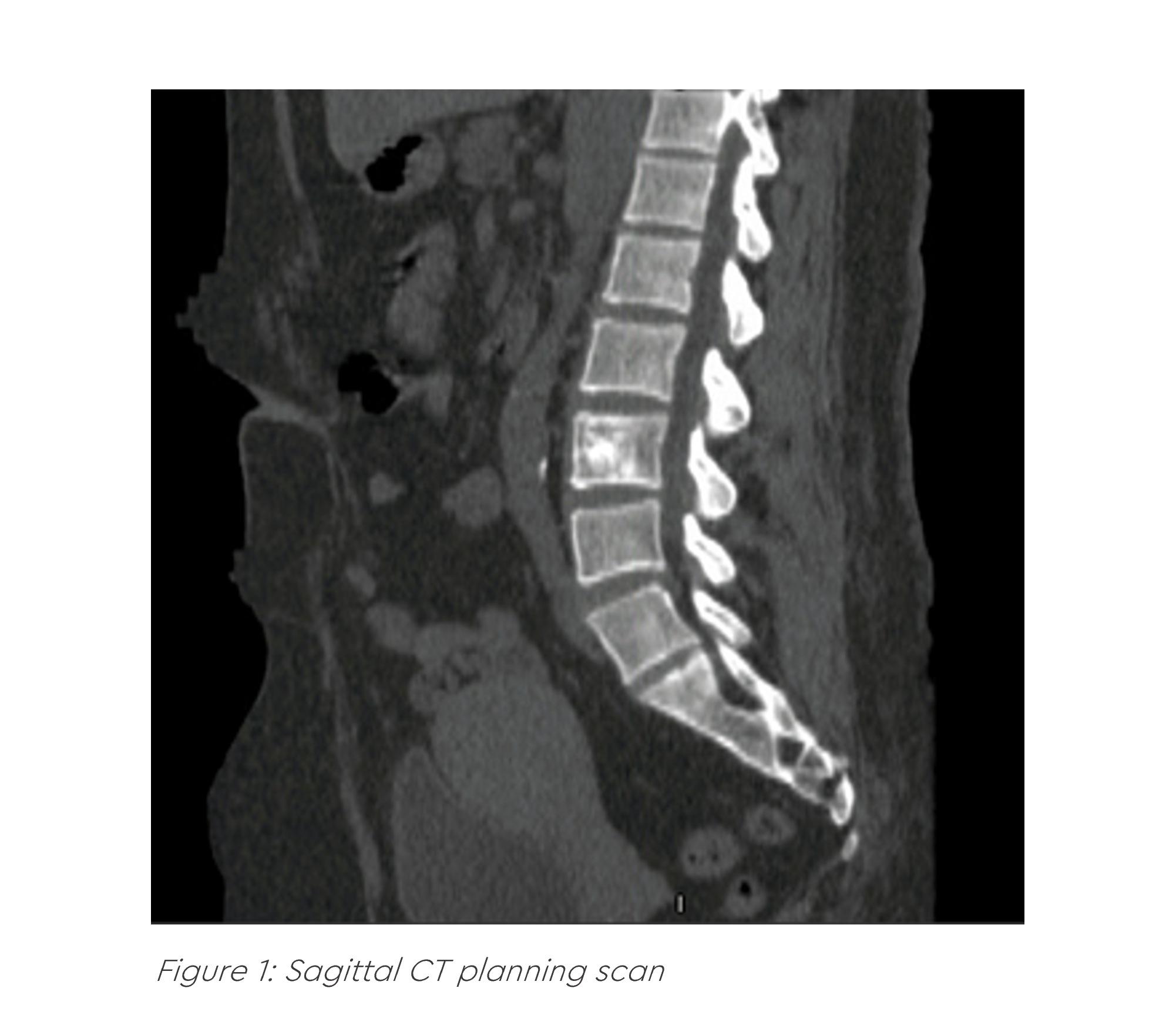 Sagittal CT planning scan