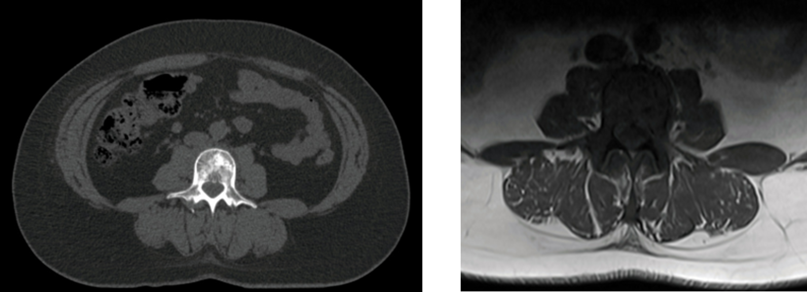 Axial CT planning scan