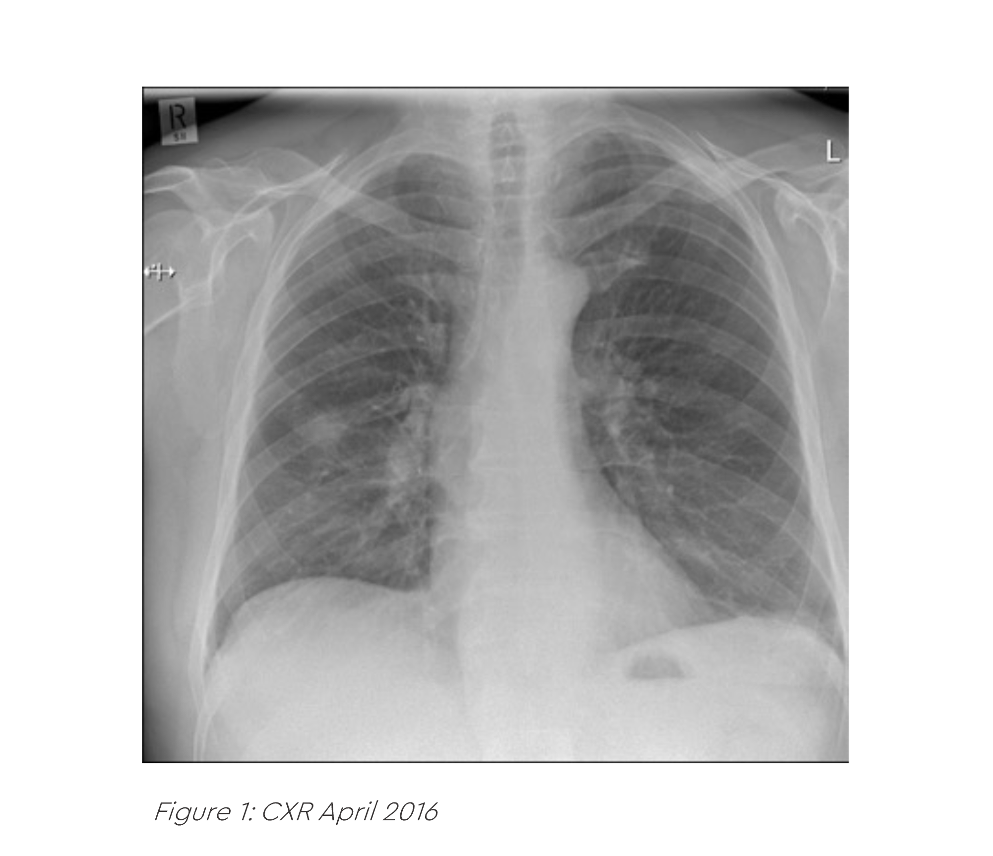 Figure 1: CXR April 2016