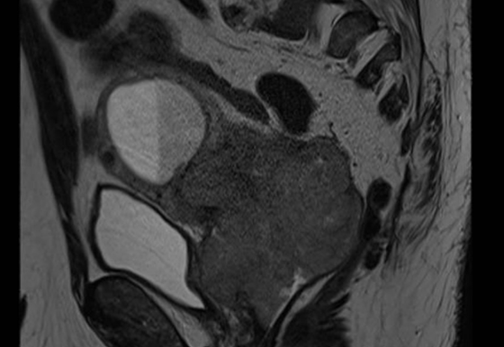 Patient with cervical cancer starting treatment