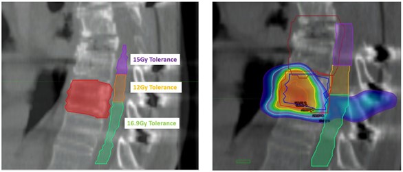 Spinal SABR plan to treat the T9 vertebral metastasis