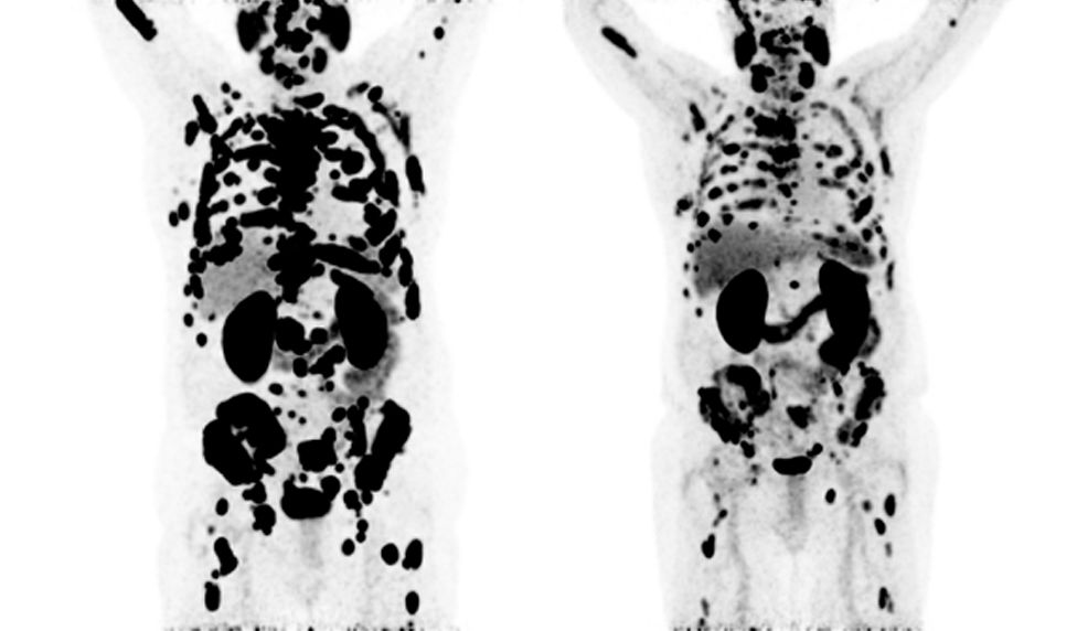 68Gallium PSMA PET/CT scans