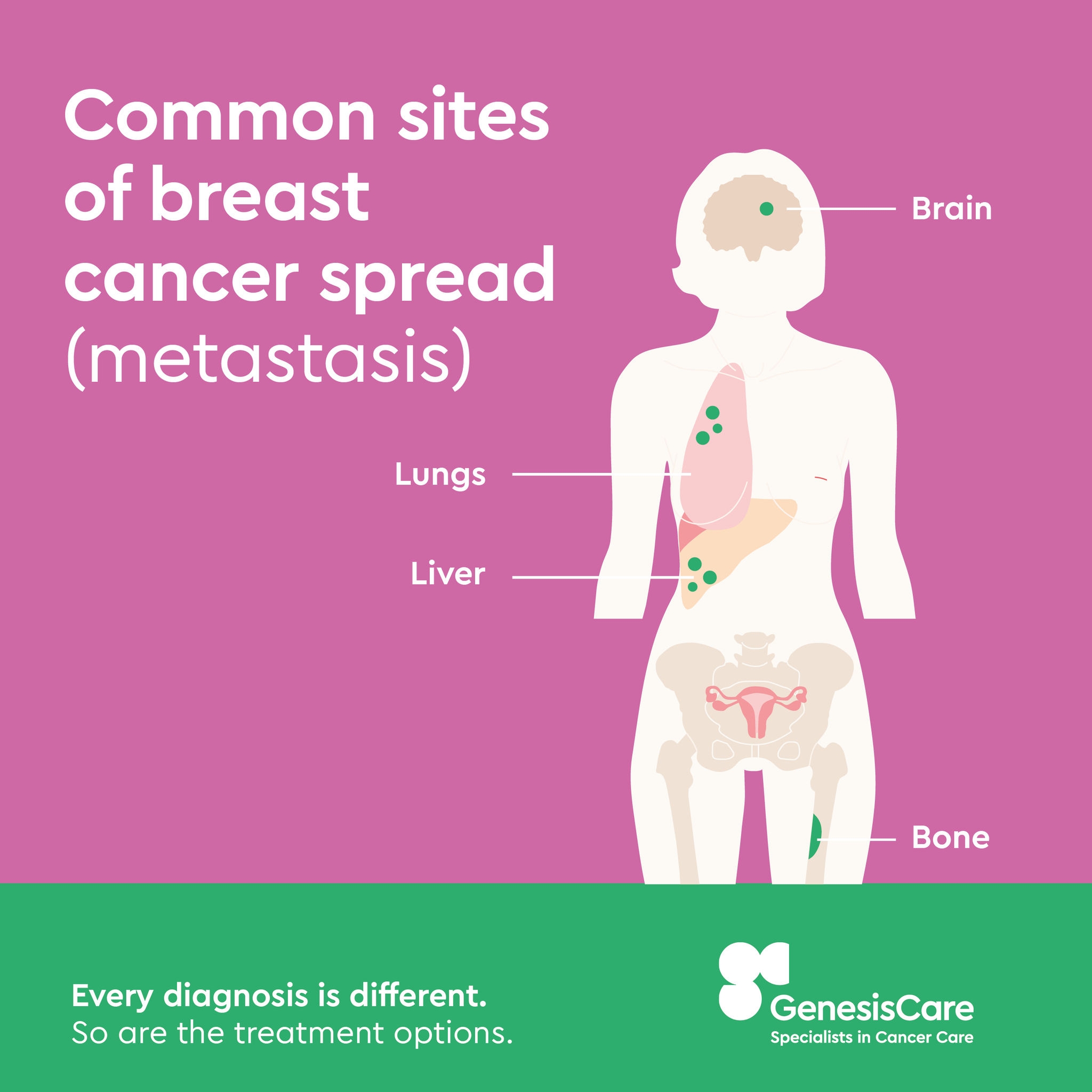 image of breast cancer spread