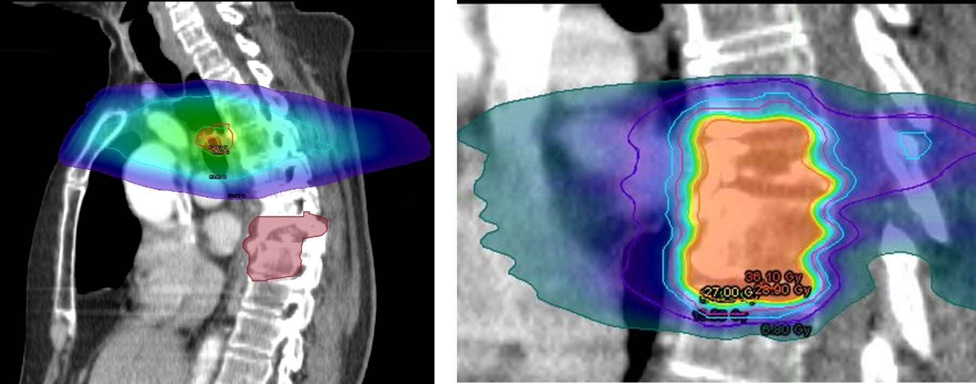 Dose planning modelled on previous treatments