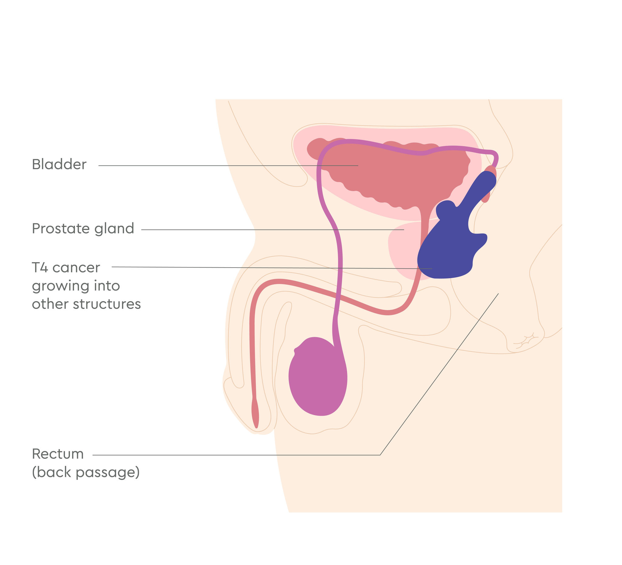 3380_UK_Prostate cancer stages illustrations_V1_FA