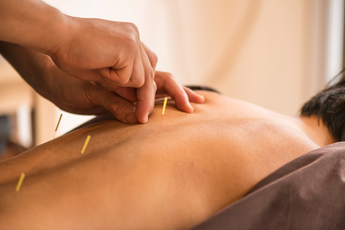 Young woman, Japanese ethnicity, at the acupuncture treatment. Hands of acupuncturists inserting needles in her back. She lies, waist up, at bright window.