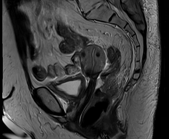 Patient with cervical cancer after treatment