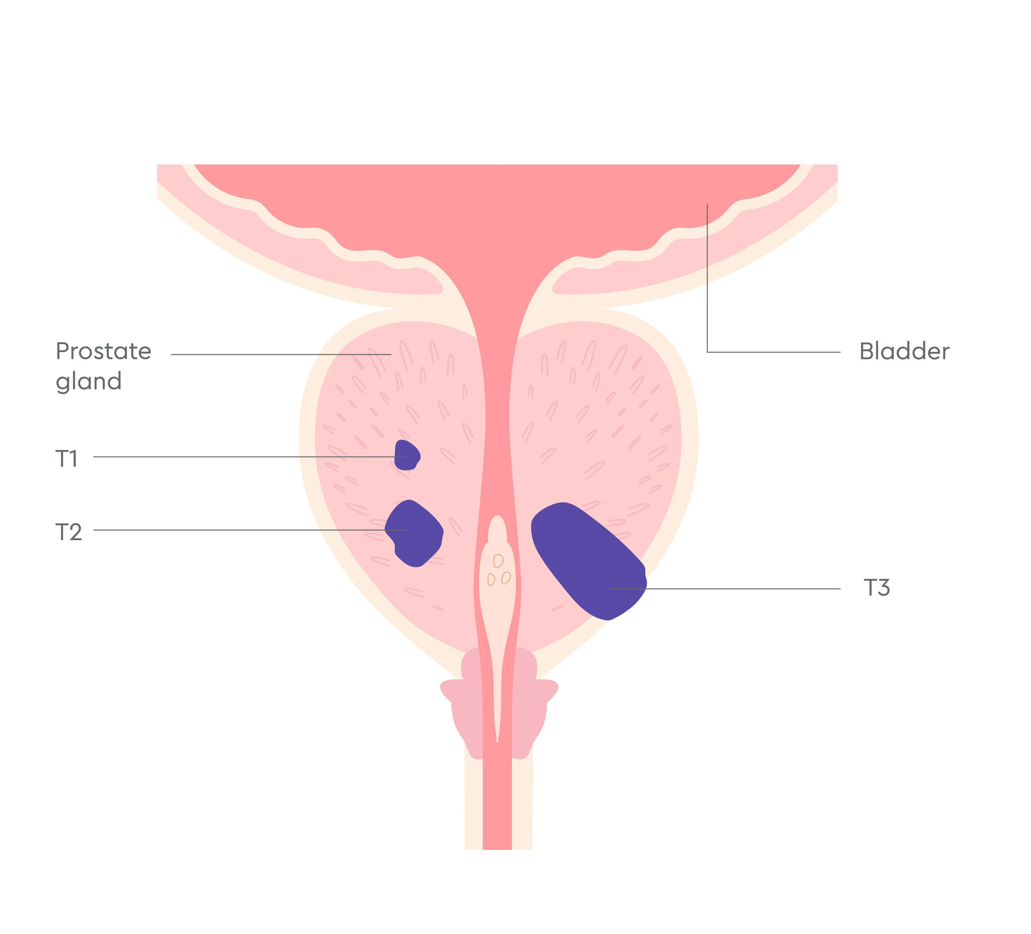 3380_UK_Prostate cancer stages illustrations_V1_FA