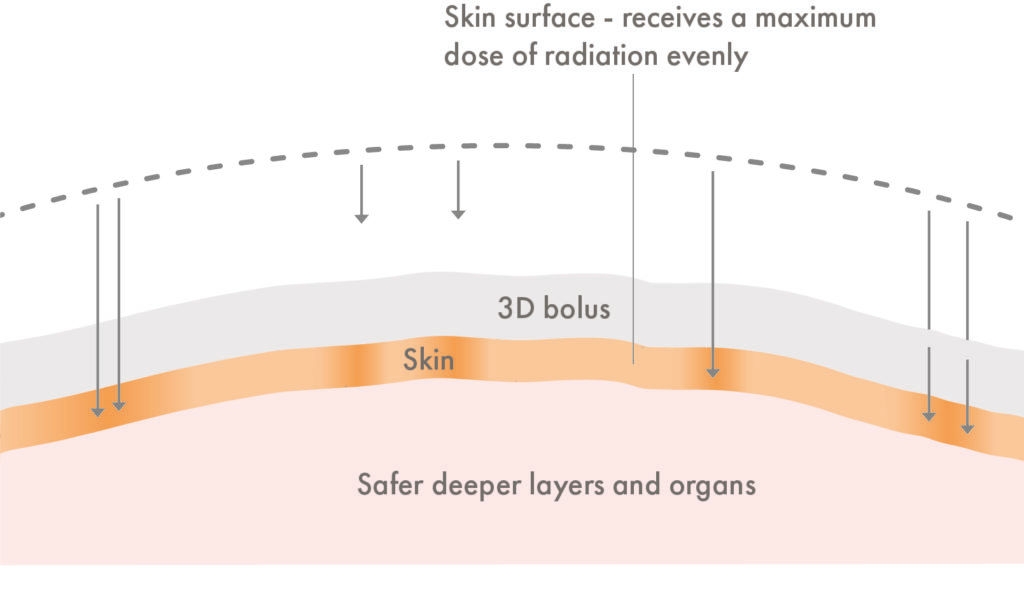 GenesisCare_Infographic_VMAT radiotherapy on skin