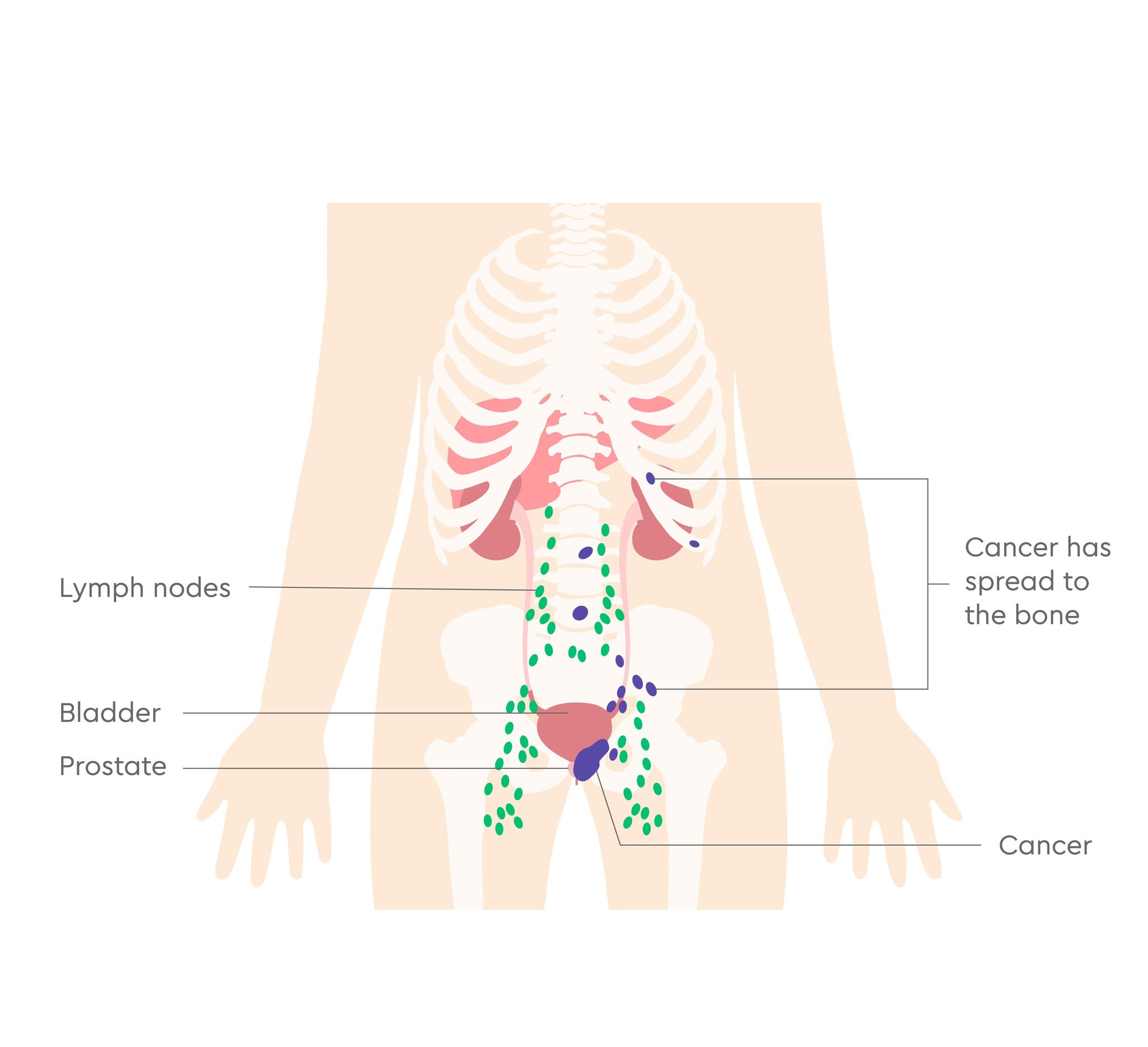 3380_UK_Prostate cancer stages illustrations_V1_FA