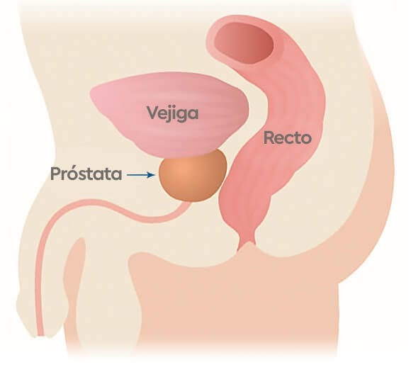 Ilustración del posicionamiento de la próstata