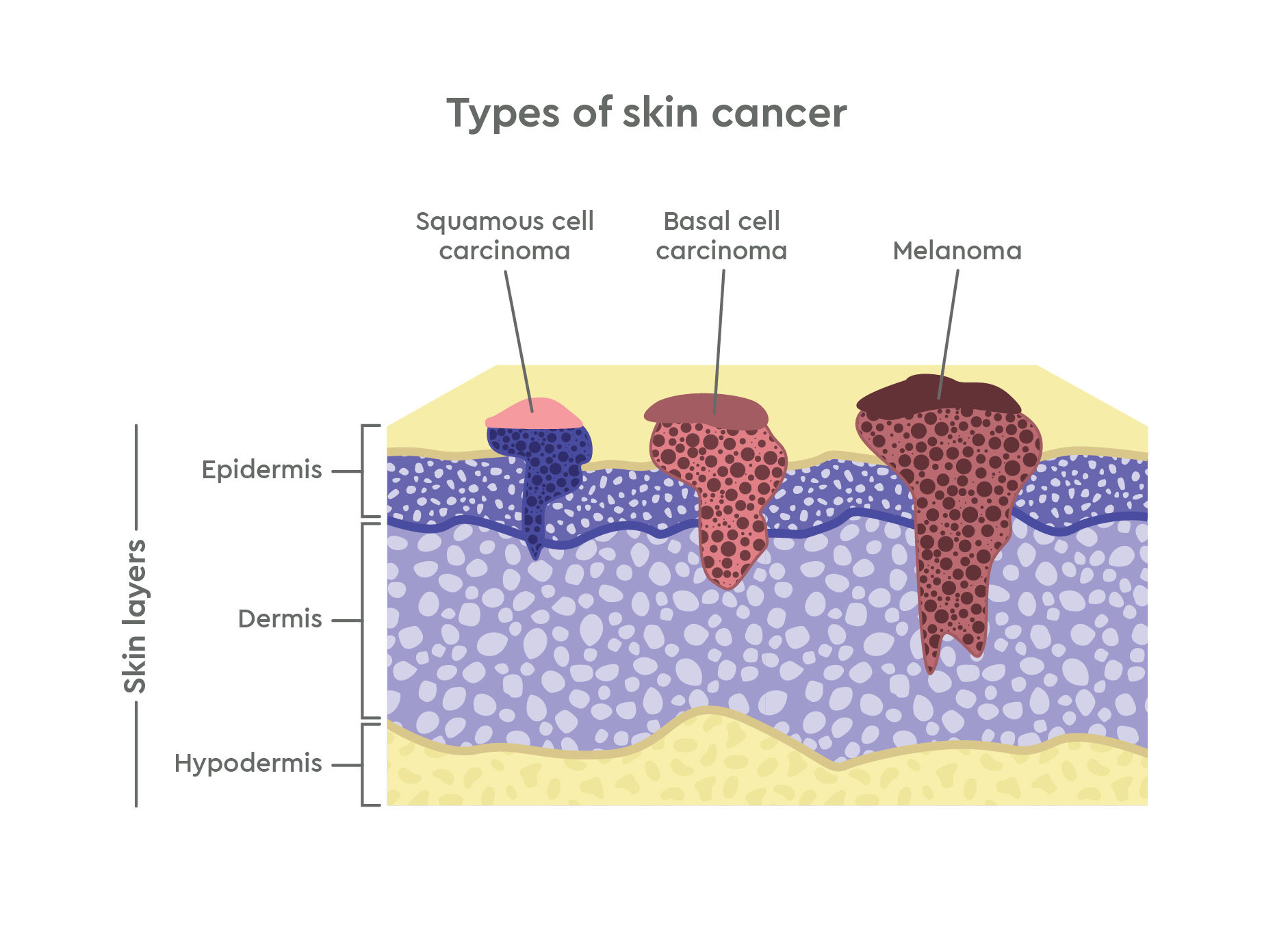 GC-Illustration-Types Of Skin Cancer