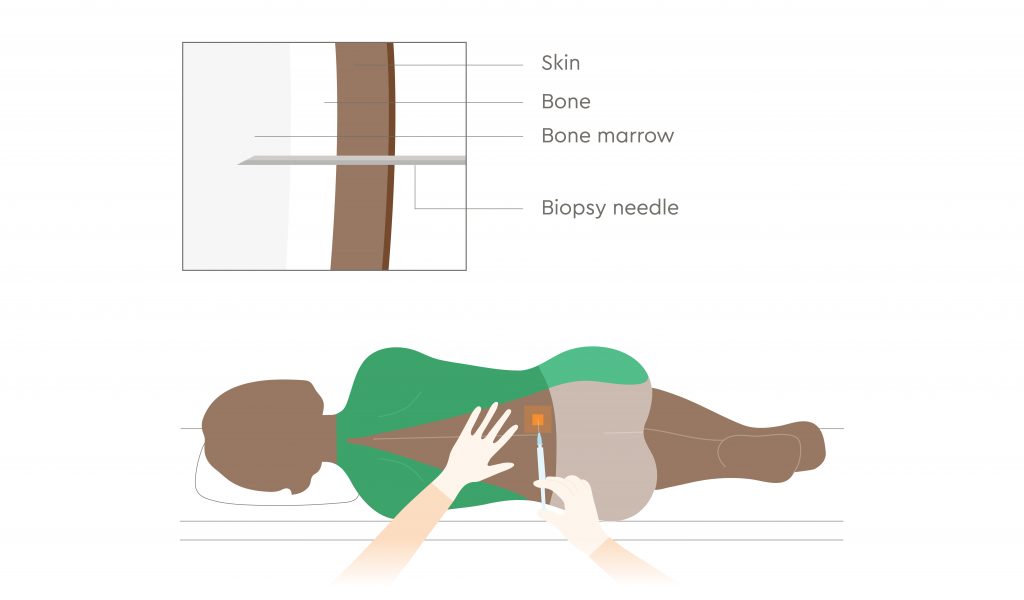 Bone marrow procedure