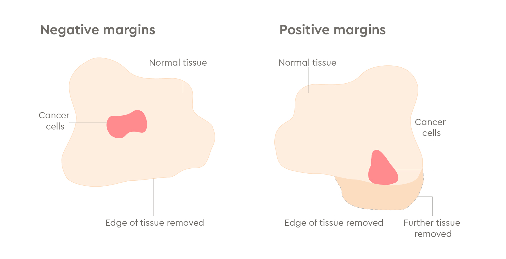 Breast illustrations | GenesisCare UK