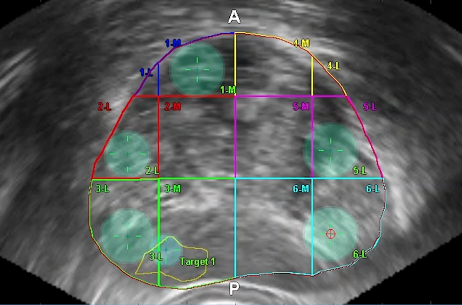UK_vector_prostate_biopsy_4