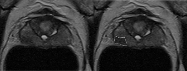 UK_vector_prostate_biopsy_P1